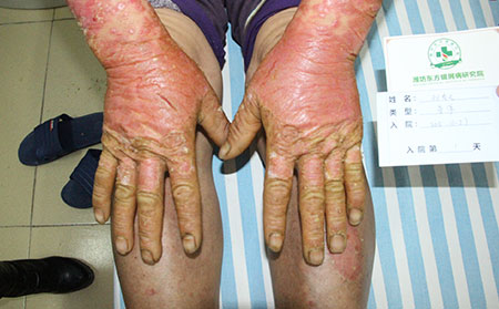 對(duì)關(guān)節(jié)型銀屑病不好的因素