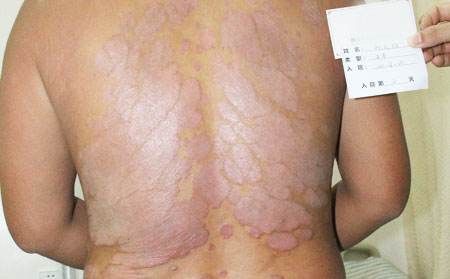 發(fā)展期銀屑病患者飲食