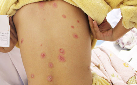 銀屑病夏天自愈