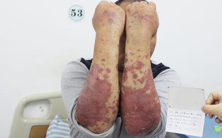 局部銀屑病治療