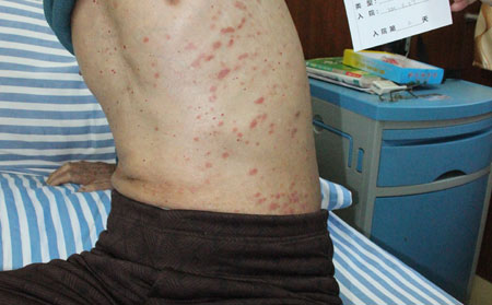 牛皮癬皮損消退