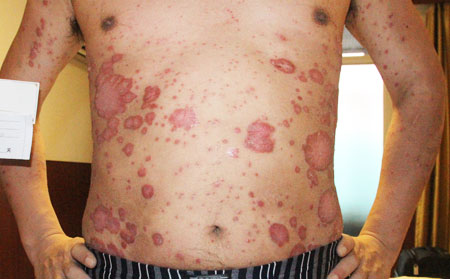 銀屑病確診檢查