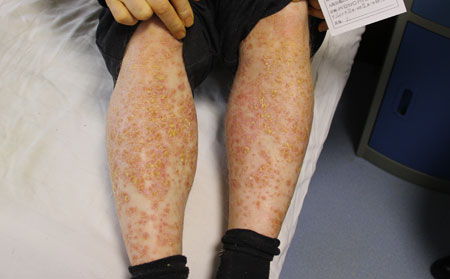 銀屑病認知誤區