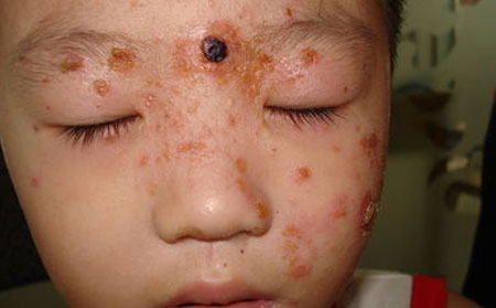 兒童銀屑病治療