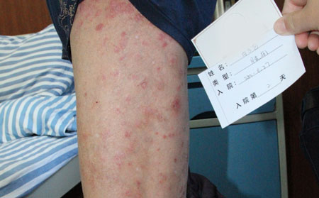 銀屑病治療禁忌