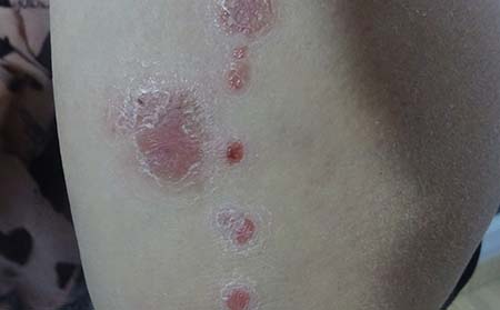 銀屑病患者細節護理