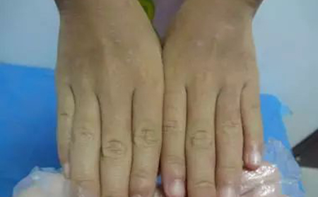 手部牛皮癬2