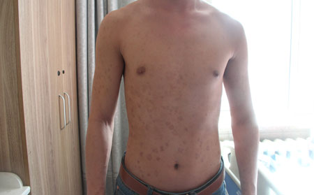 牛皮癬中醫治療