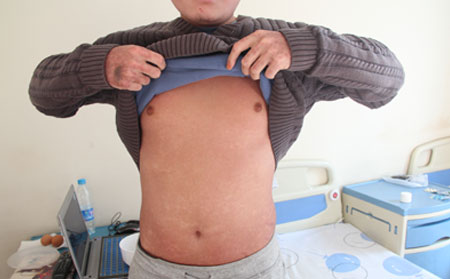 牛皮癬護(hù)理