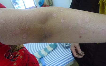 銀屑病患者護理皮膚