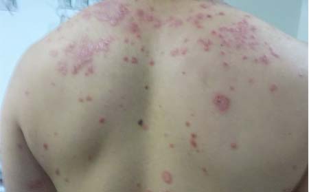 為什么不治療銀屑病