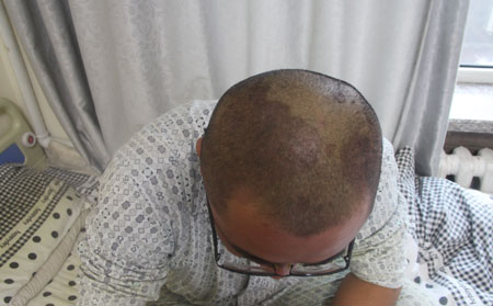 頭部為何長滿銀屑病