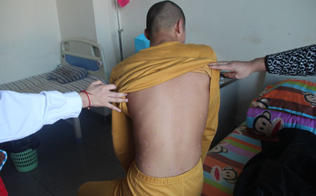 預防銀屑病復發的辦法