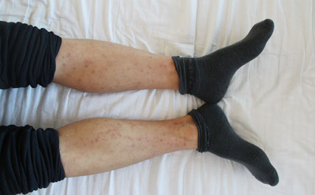 腿部銀屑病的護理