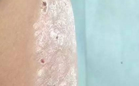 銀屑病護理細節