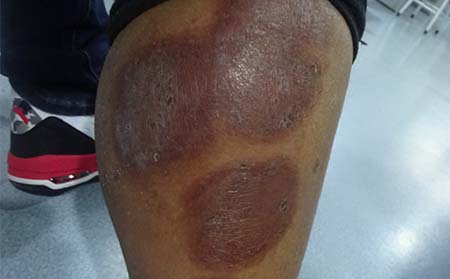 濰坊銀屑病醫院治療