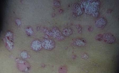 銀屑病患者的正確護理