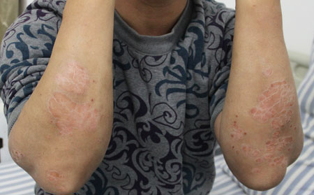 胳膊肘尋常型銀屑病