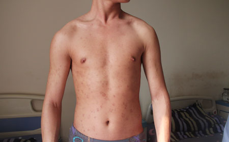 一些不被重視的銀屑病原因