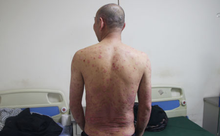 銀屑病冬季防治