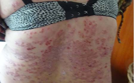 冬季護理膿皰型銀屑病