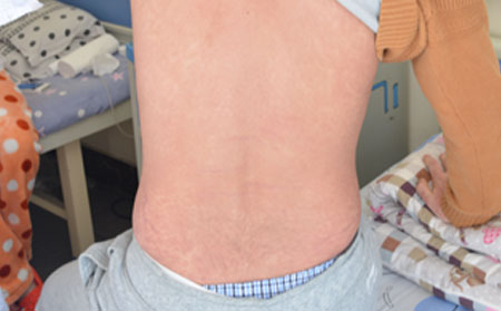 濰坊哪里治療銀屑病