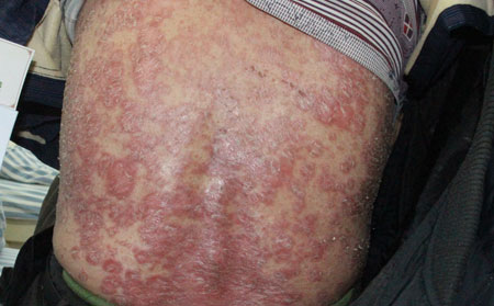 寒冷季節銀屑病怎么護理