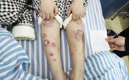 銀屑病為什么老是發作