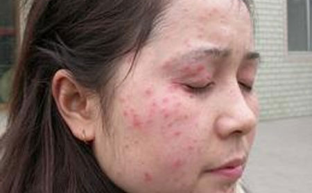 牛皮癬該怎么預防