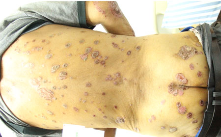 銀屑病的護理方法