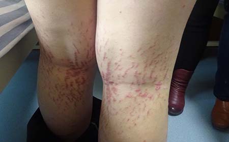 牛皮癬損害健康