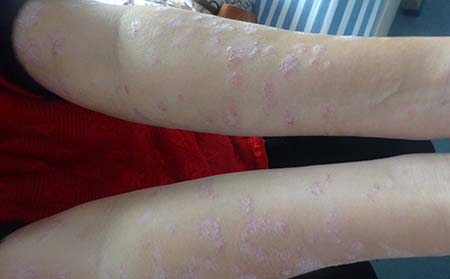 實現銀屑病快速恢復的辦法