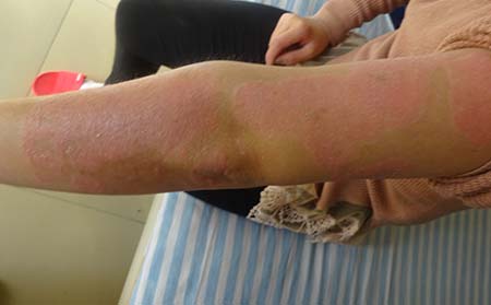 濰坊東方銀屑病研究院治療效果怎么樣