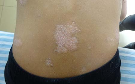 濰坊東方銀屑病研究院治療用藥