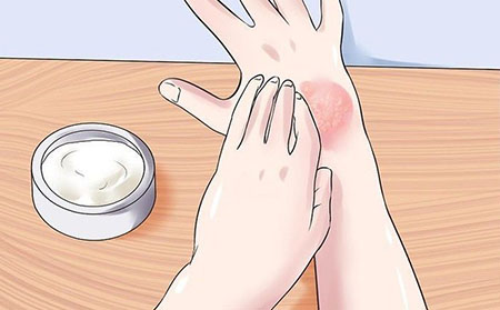 銀屑病的治療方法有什么