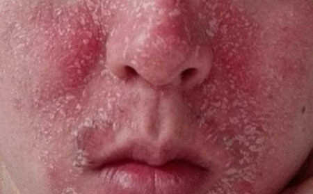 東方銀屑病在線解答