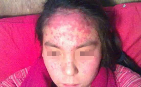 東方銀屑病治尋常型牛皮癬