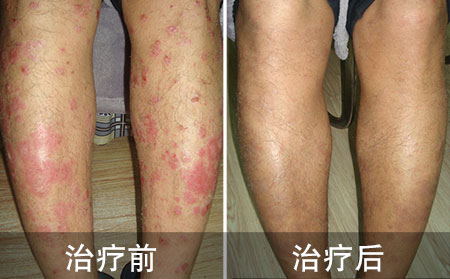 濰坊東方銀屑病怎么治療