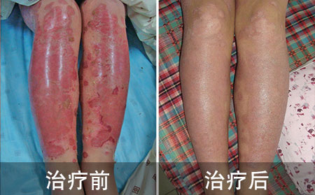 銀屑病怎么治療比較好