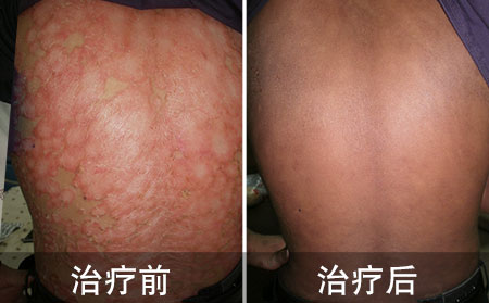 治療銀屑病用什么方法
