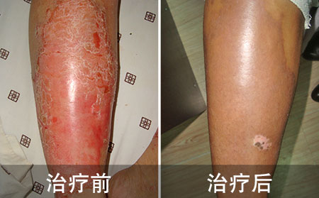 治療銀屑病用什么方法