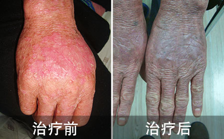 銀屑病的治療方法