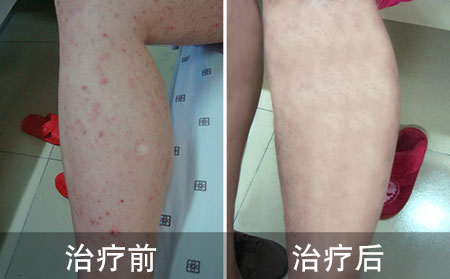 怎么治療銀屑病