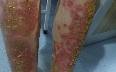 銀屑病應該怎么治療