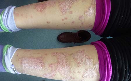 尋常型牛皮癬不斷惡化怎么辦