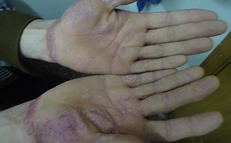 高考結(jié)束趕緊治療銀屑病 別帶銀屑上大學(xué)