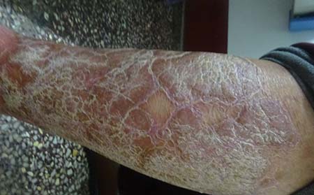 兒童銀屑病治療