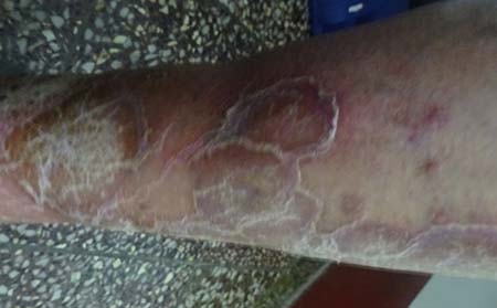 學(xué)生夏季治療銀屑病 我的青春不留屑