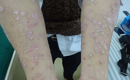 如何在治療患者銀屑病病情中做到專門治療