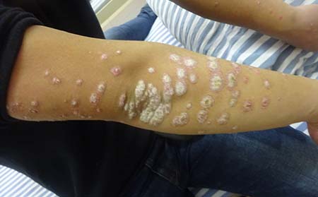 銀屑病的護理方法有什么